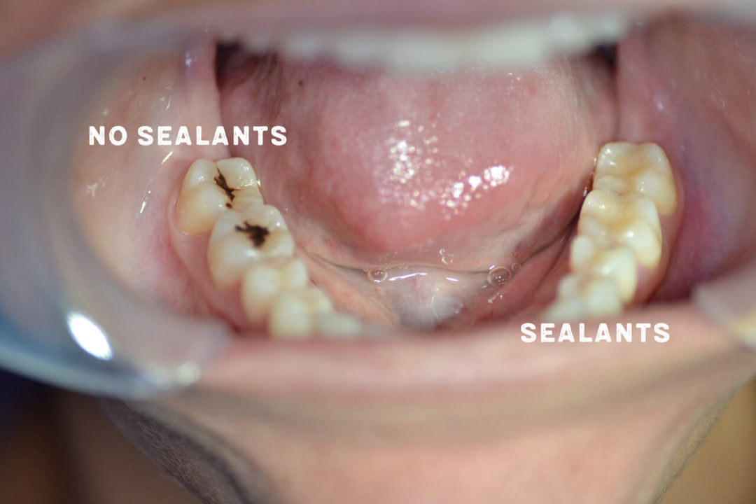 What are dental sealants and why does my child need them? Kids Teeth