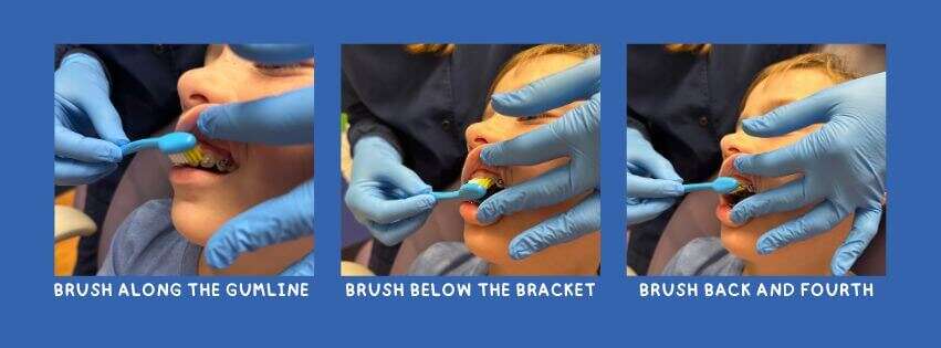 Brushing with Braces 