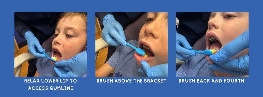 Brushing with braces
