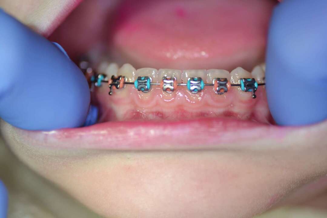 brushing with braces