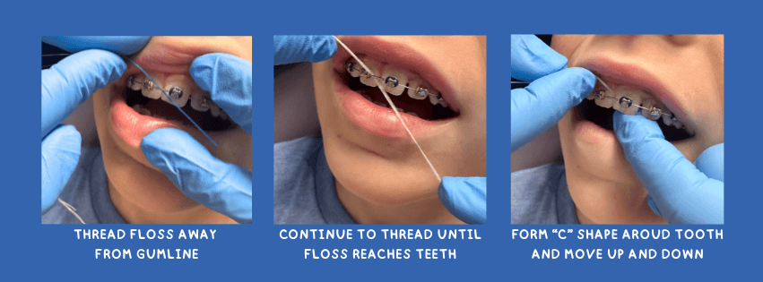 How to floss with braces